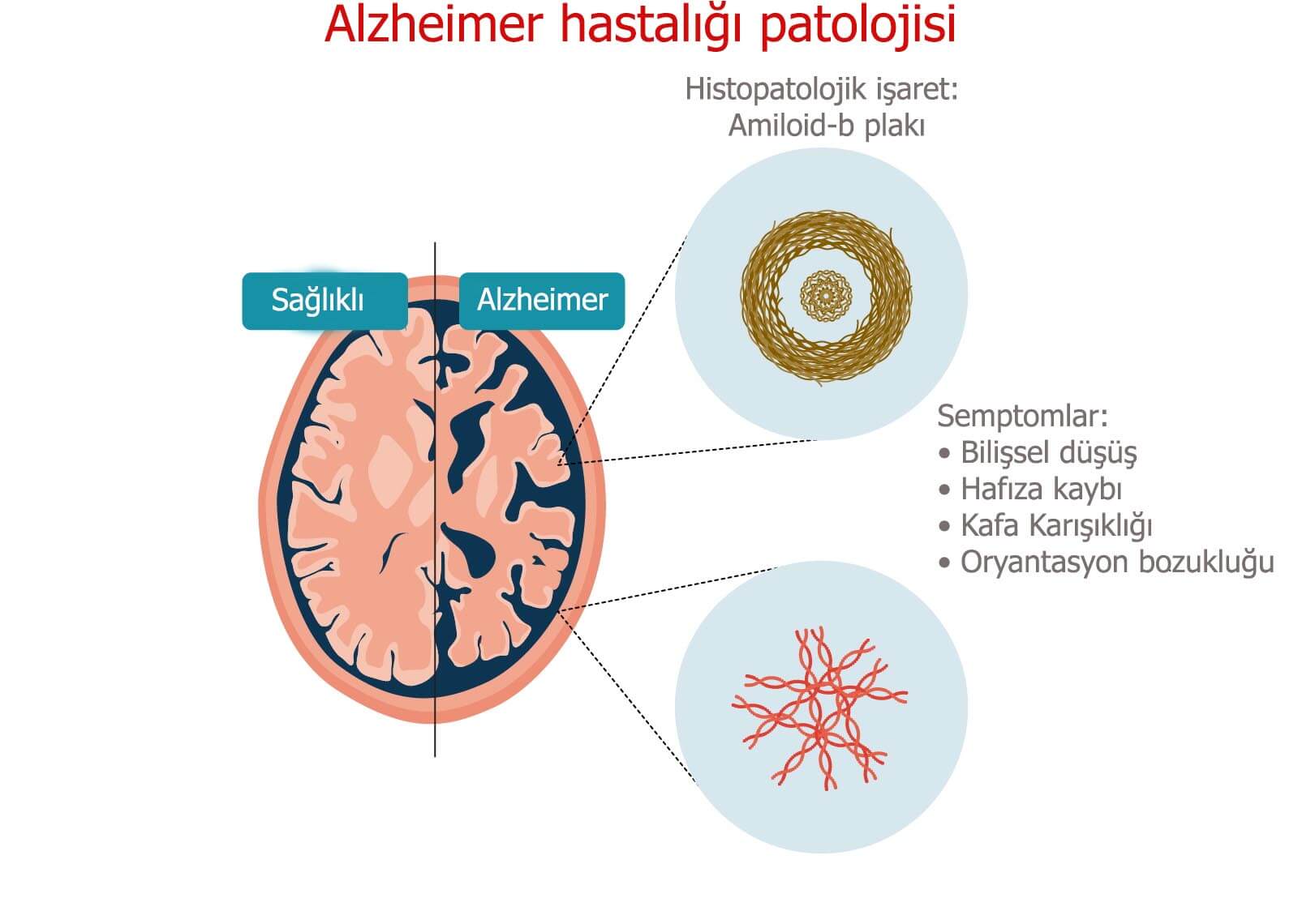 alzheimer hastalığı patolojisi